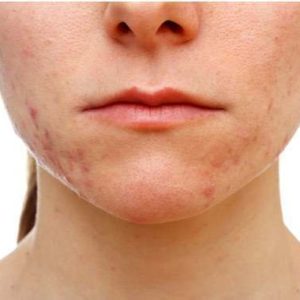 radiofrequenza viso acne